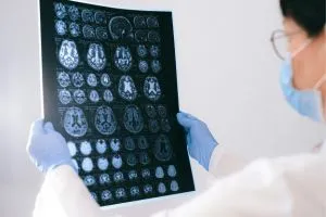 Un docteur tient en main les scans d'un cerveau déficient en oméga-3.