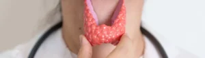 Une illustration de thyroïde sur le cou d'une femme qui souffre d'hypothyroïdie.