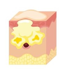 Production excessive de sébum qui favorise l'acné dans le dos