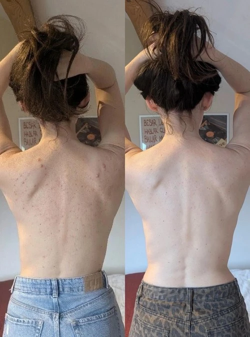 Avant/après d'une jeune femme avec de l'acné hormonale dans le dos.
