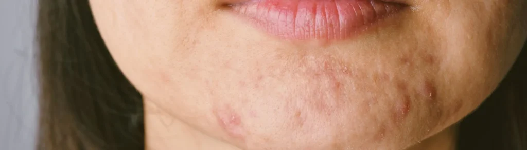 Un menton de femme recouvert d'acné hormonale.