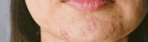 Un menton de femme recouvert d'acné hormonale.